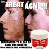 Cream Blemish Treatments Fresh acne cream lotion high strength ingredients